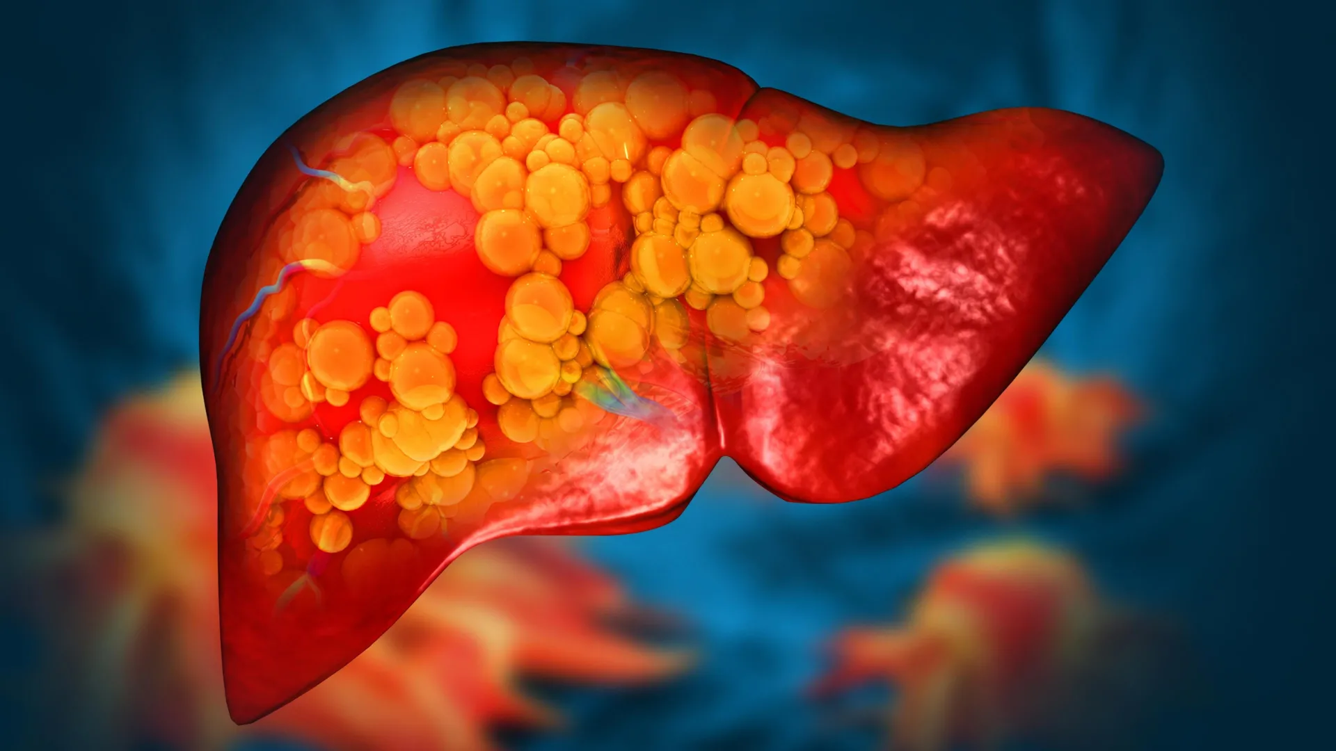 Rare MET gene mutation linked to fatty liver disease